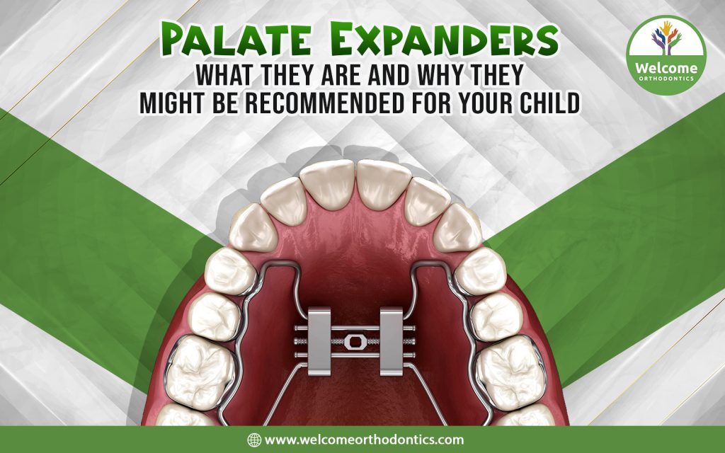 Palate Expanders: What They Are and Why They Might Be Recommended for Your Child