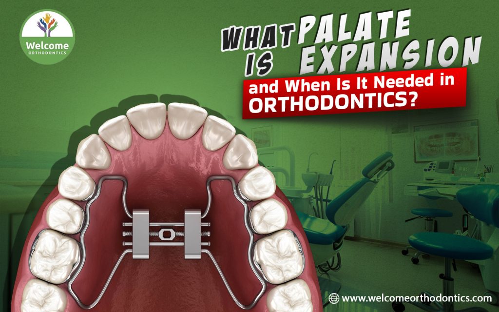 What Is Palate Expansion, and When Is It Needed in Orthodontics?