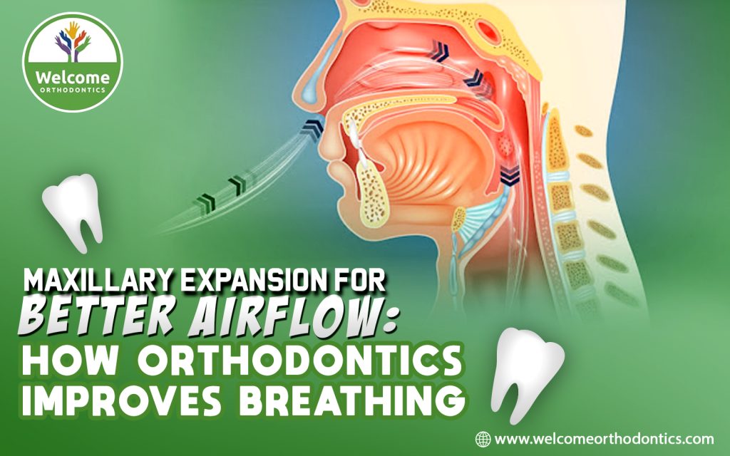 What Is Maxillary Expansion?