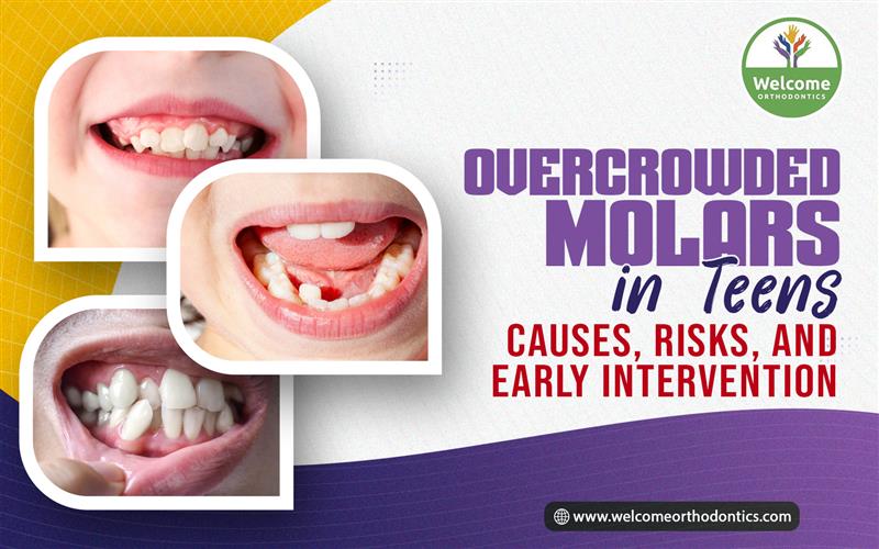 Illustration for Overcrowded Molars in Teens: Causes, Risks, and Early Intervention