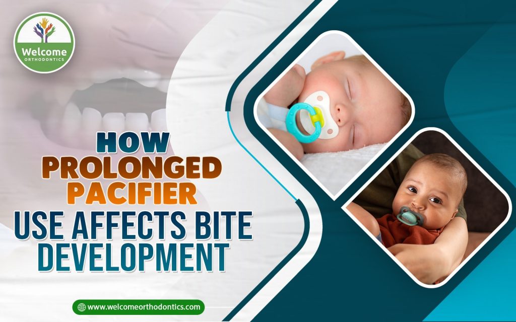 Illustration for How Prolonged Pacifier Use Affects Bite Development
