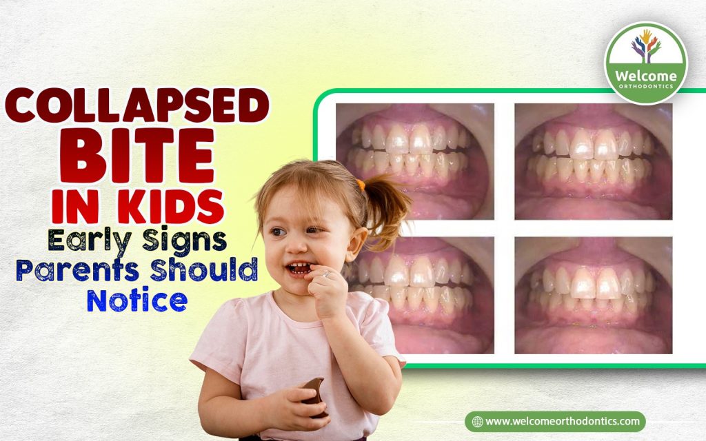 Illustration for Collapsed Bite in Kids: Early Signs Parents Should Notice