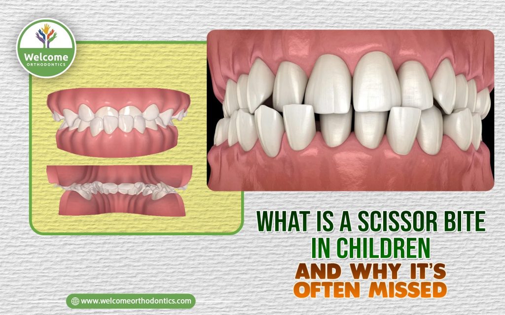 Illustration for What Is a Scissor Bite in Children and Why It’s Often Missed