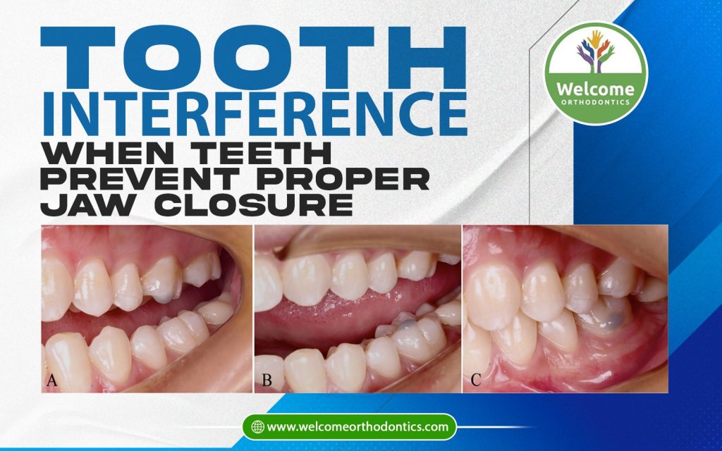 Illustration for Tooth Interference: When Teeth Prevent Proper Jaw Closure