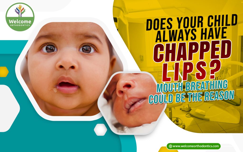 Illustration for Does Your Child Always Have Chapped Lips? Mouth Breathing Could Be the Reason