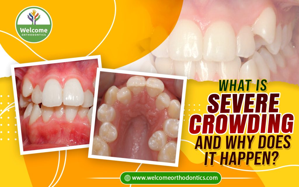 Illustration for What Is Severe Crowding and Why Does It Happen?