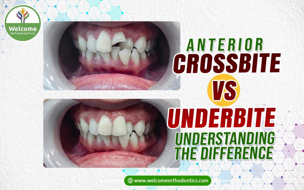 Images For : Anterior Crossbite vs Underbite: Understanding the Difference