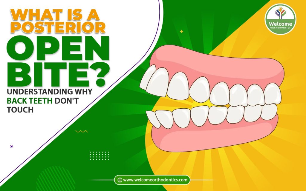 Illustration for What Is a Posterior Open Bite? Understanding Why Back Teeth Don’t Touch